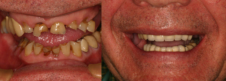 Compete Dental Rehabilitation
