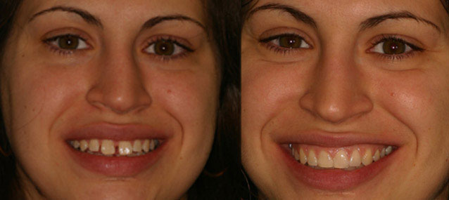 Invisalign - Invisable Braces