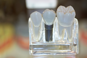 Are Dental Implants The Right Solution for You?