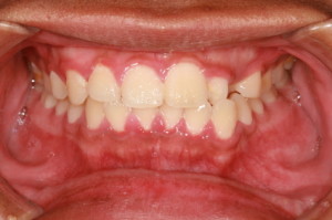 A person with gingivitis - an early stage of periodontal disease