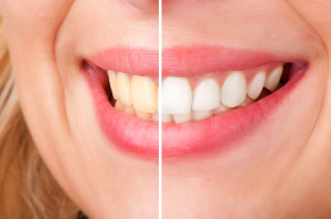 Is It Time for Cosmetic Teeth Whitening? Five Common Questions
