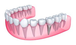 The Two Main Types Of Dental Implants