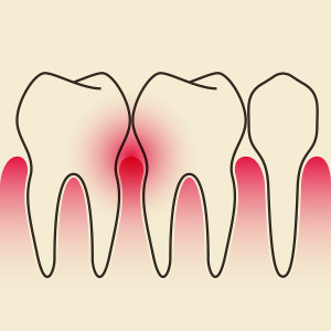 What Should I Do If My Gums Are Bleeding?