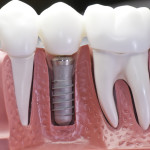 Are Dental Implants Appropriate For Elders