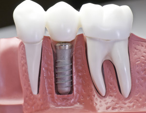 Are Dental Implants Appropriate For Elders