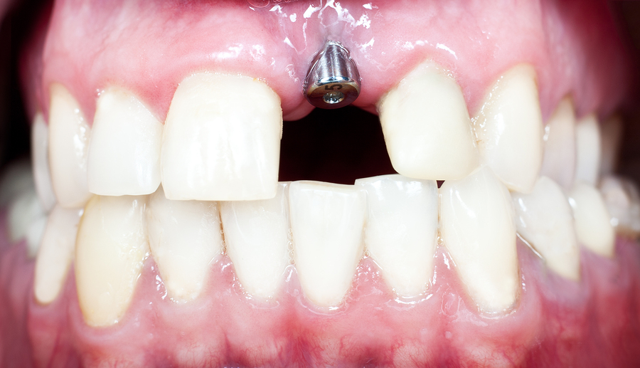 long recovery teeth implants