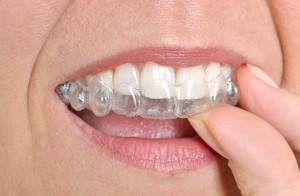 Invisalign Beats Traditional Braces Hands Down