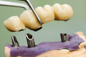 What Should You Consider Before Getting Dental Implants?
