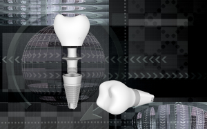 Modern Dental Implants Look And Feel Just Like Original Teeth