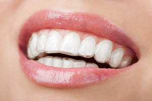 Younger And Mature Patients Prefer Clear Braces Hands Down!