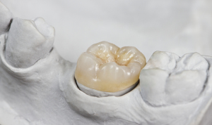 A Brief Overview Of Dental Inlays And Overlays