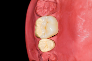 How Do Dental Inlays And Onlays Differ?