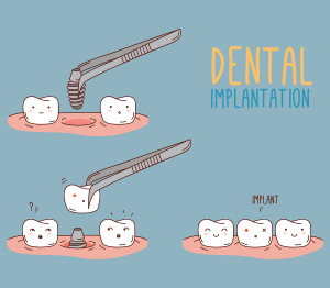 Possible Causes Of Dental Implant Failure