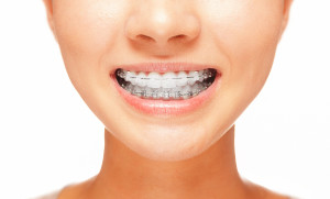 Pros And Cons Of The Different Types Of Braces