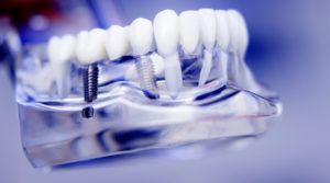Information To Help Patients Decide If They Are Ideal Candidates For Dental Implants