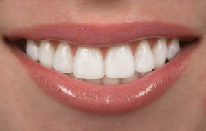 Achieve Straight, White Teeth With Veneers