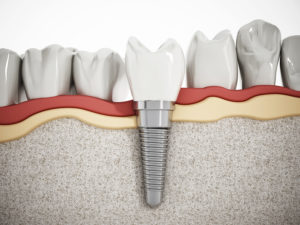 The Ins And Outs Of How A Body Rejects Dental Implants